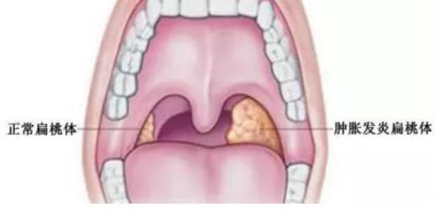 怎么治疗扁桃体炎