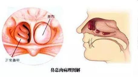 鼻息肉有哪些危害