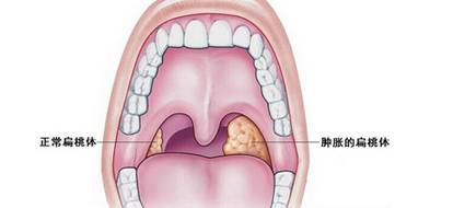 扁桃体炎的症状有哪些呢？