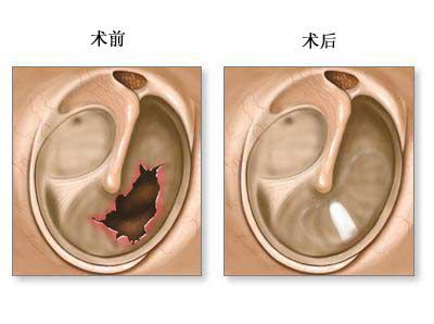 鼓膜穿孔的表现