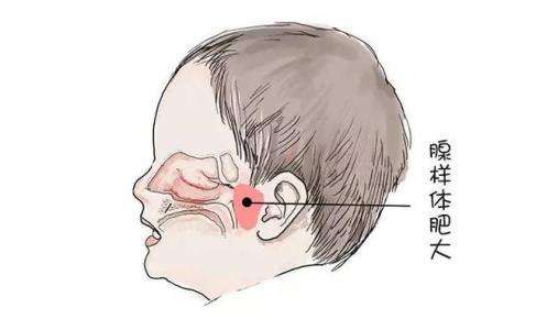 得了腺样体肥大怎么治
