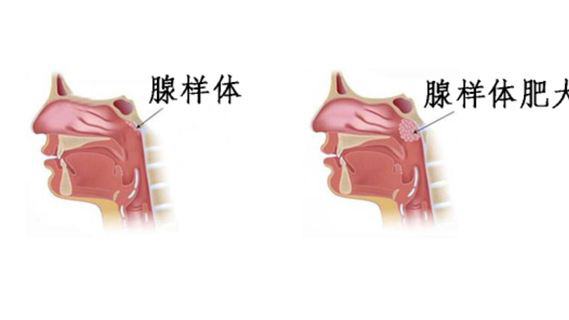 腺样体肥大的症状有哪些？