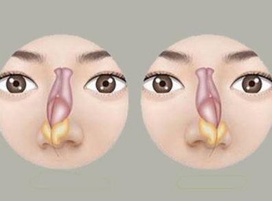 鼻中隔偏曲的表现症状有哪些呢？