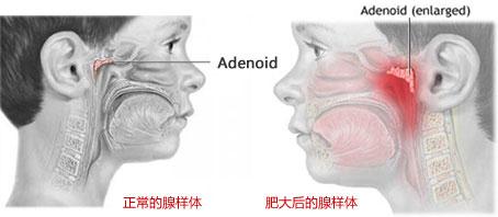 腺样体肥大的症状