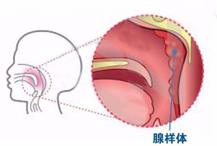 腺样体