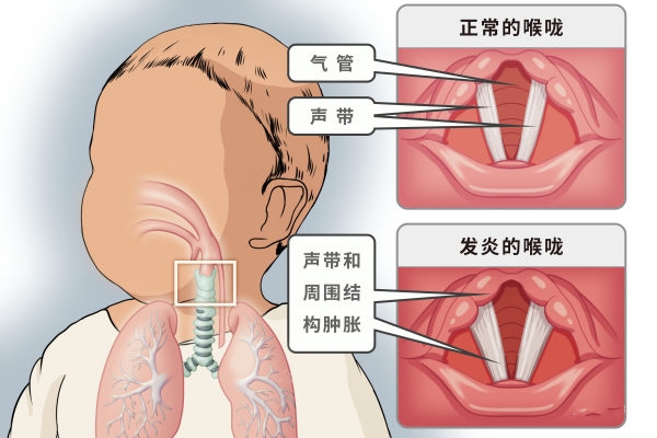 咽炎和喉炎的区别