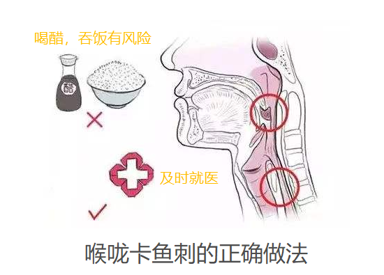 卡鱼刺的处理