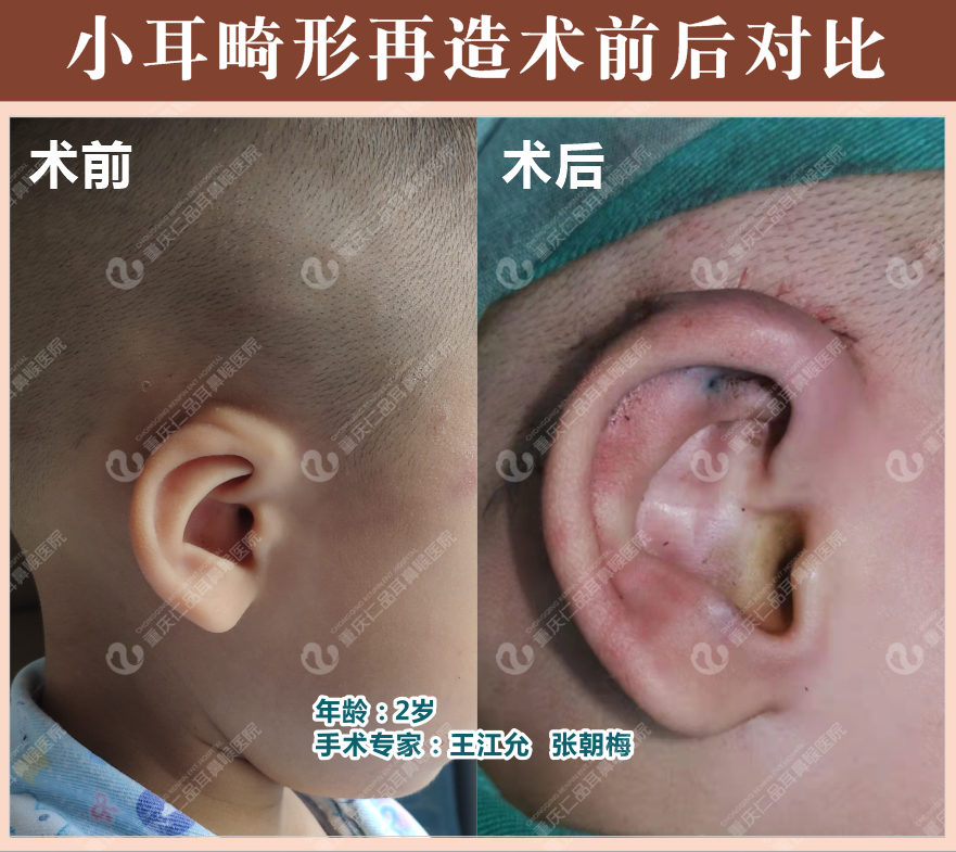 人工耳蜗植入案例
